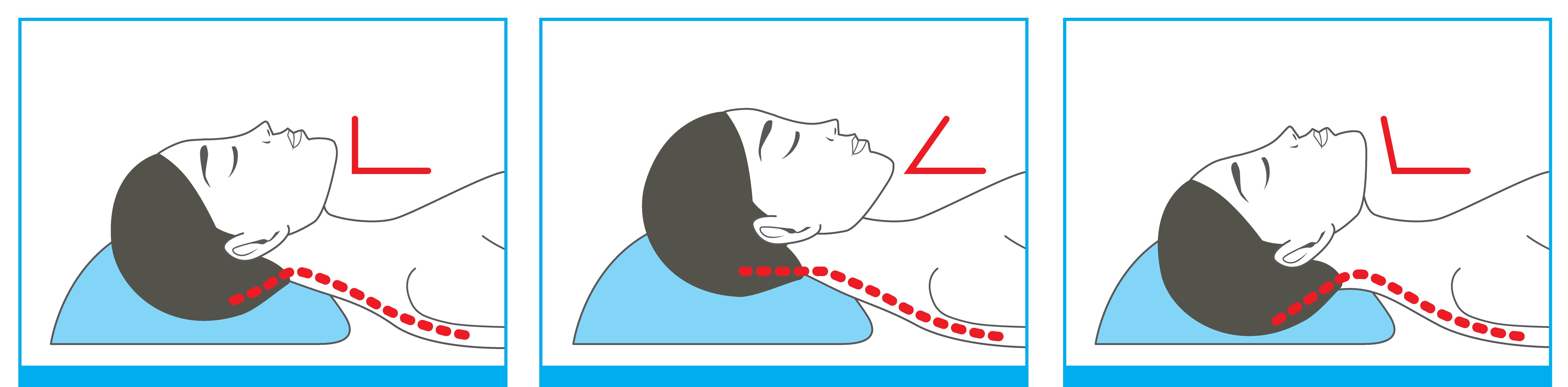 Как правильно спать при остеохондрозе шейного отдела позвоночника фото